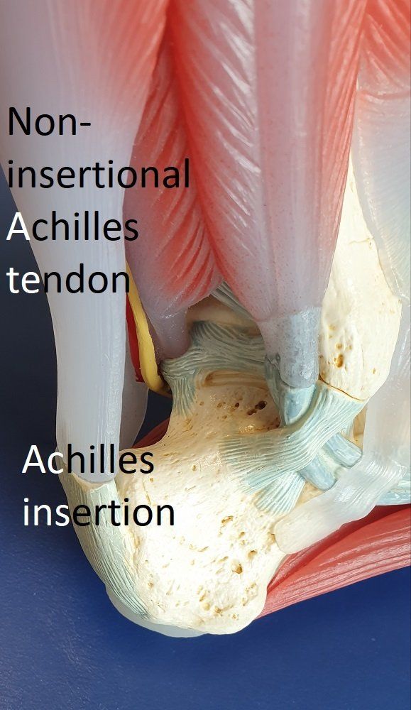 Achilles Tendinopathy Dr Ben Beamond Adelaide